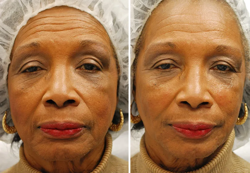 Photo of the patient’s face before and after Restylane & Perlane treatment. Patient 17 - Set 1