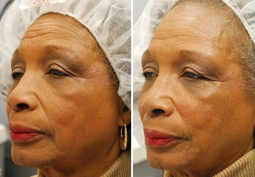 Photo of the patient’s face before and after Restylane & Perlane treatment. Patient 17 - Set 2