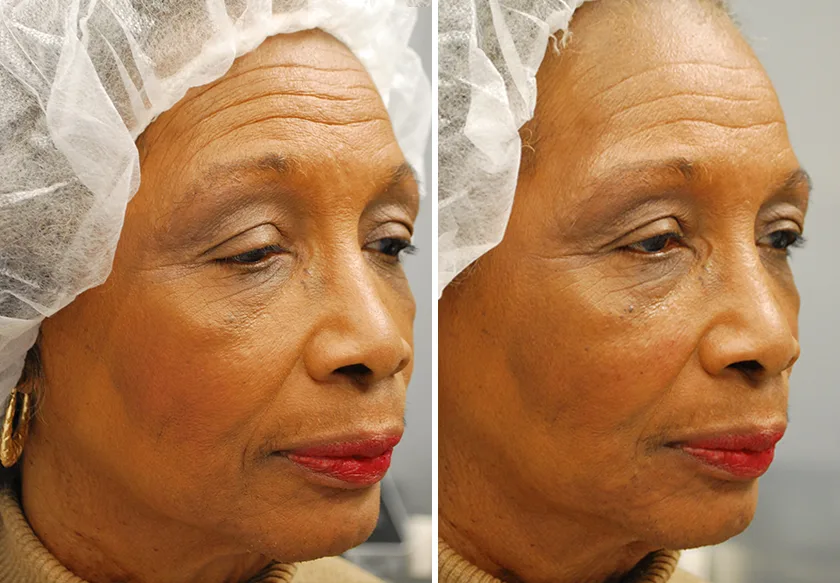 Photo of the patient’s face before and after Restylane & Perlane treatment. Patient 17 - Set 3