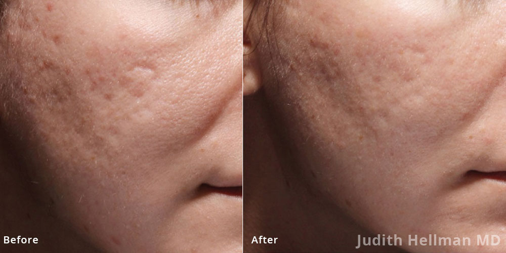 Bellafill - Before and After Treatment Photos - patient 1 (face, oblique view)