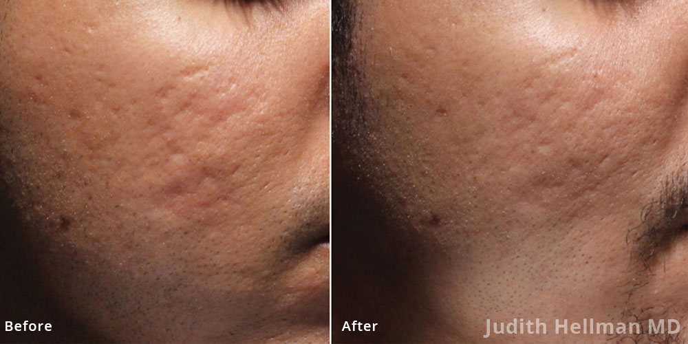 Bellafill - Before and After Treatment Photos - patient 2 (cheek, oblique view)