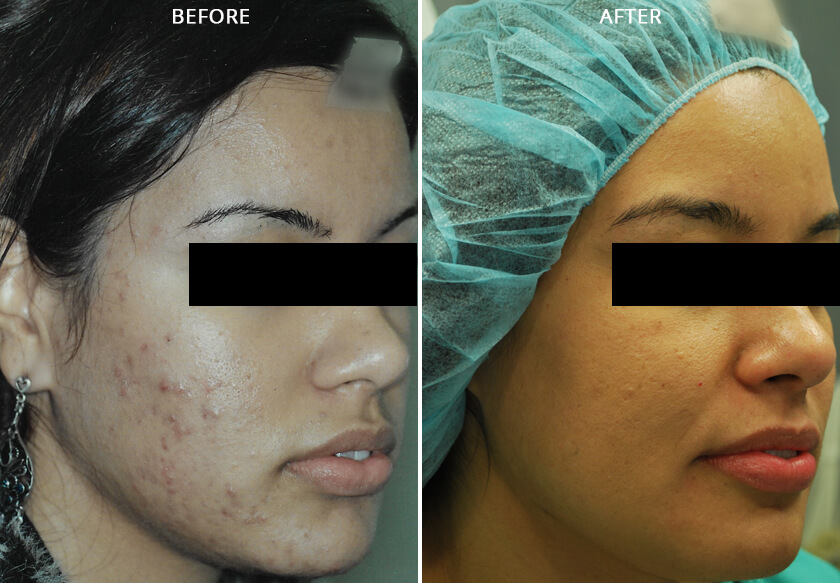 Woman's face, before and after Acne Laser Treatments, right side oblique view