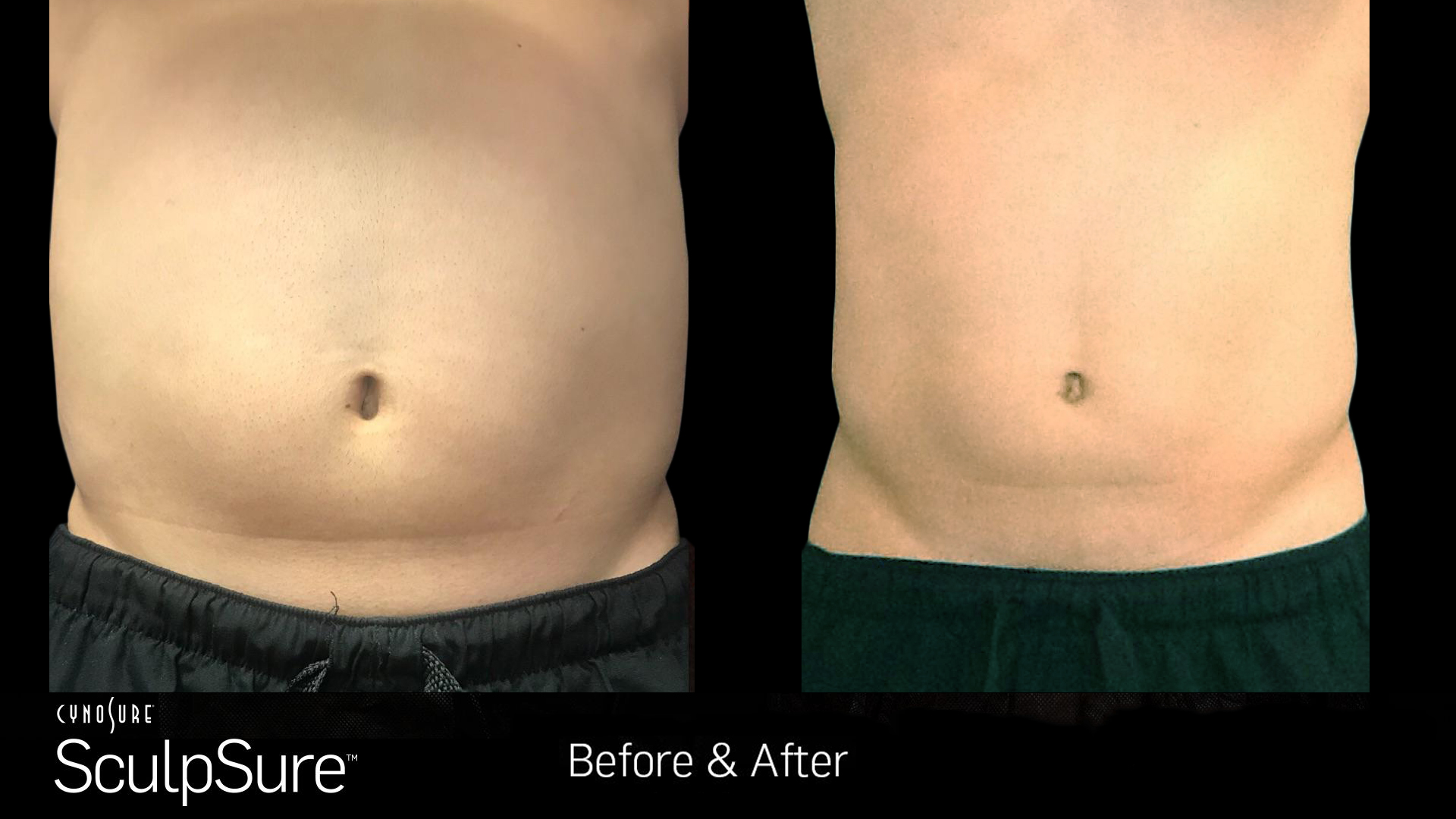 Male body, before and after SculpSure fat removal treatment, front view