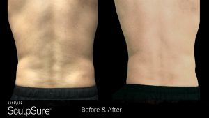 Male body, before and after SculpSure fat removal treatment, back view 