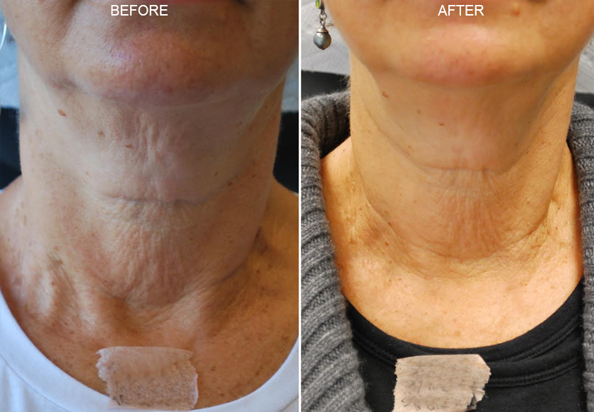 Botox & Dysport Before and After Photos NY