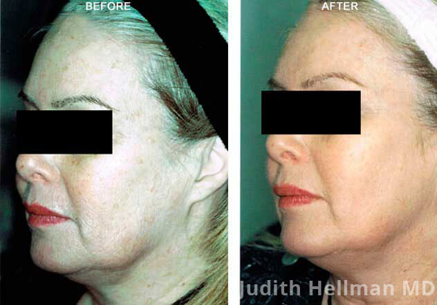 Woman's face, CO2  Laser - Before and After Treatment Photos: Female patient 5 (left side, oblique view)
