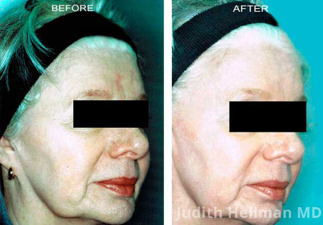 Woman's face, CO2  Laser - Before and After Treatment Photos: Female patient 5 (right side, oblique view)