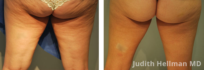 Morpheus8, Cellulite Removal treatment photos. Female - legs, buttocks, back view. Patient 1