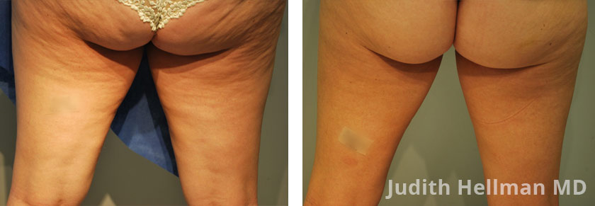 Cellulite Removal Before & After Photos