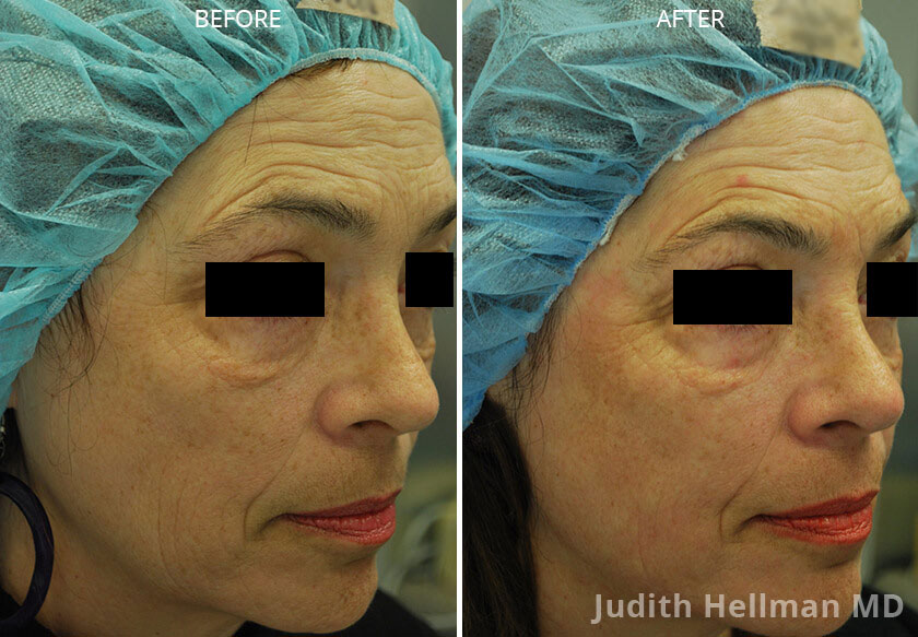 Woman's face, CO2  Laser - Before and After Treatment Photos: Female patient 1 (right side, oblique view)