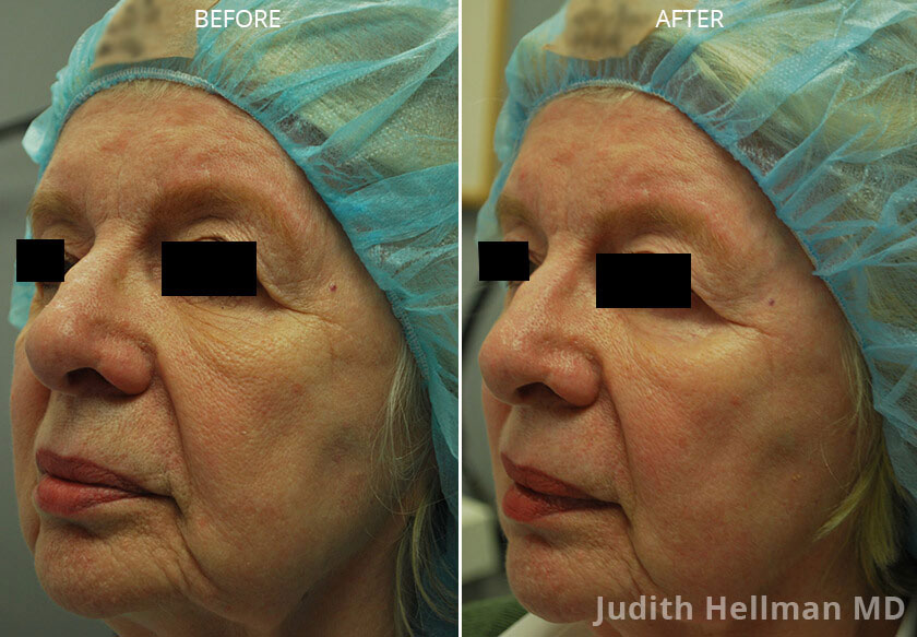 London Medical Spa - CO2 LASER RESURFACING 2/15/22. - Dr. Hal London Here  is another aggressive CO2 laser treatment of the face. This lovely patient  of mine asked me what would make