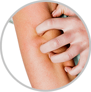 Eczema and Allergic Reactions