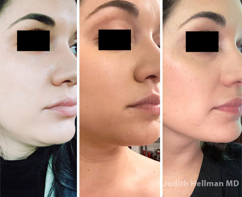 Woman's face, before and after Evoke – Facial Remodeling treatment, oblique view