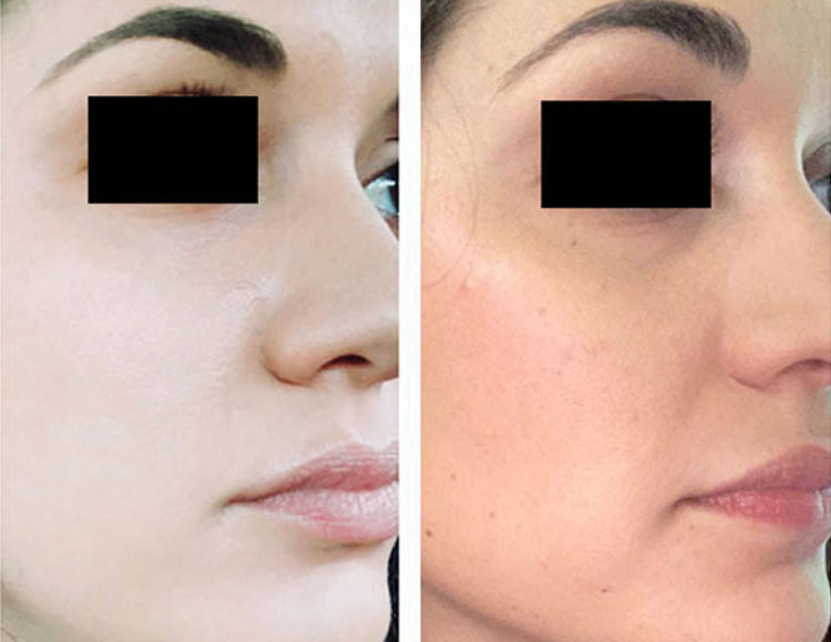 Woman's face, before and after facial,jawline and neck countouring, oblique view