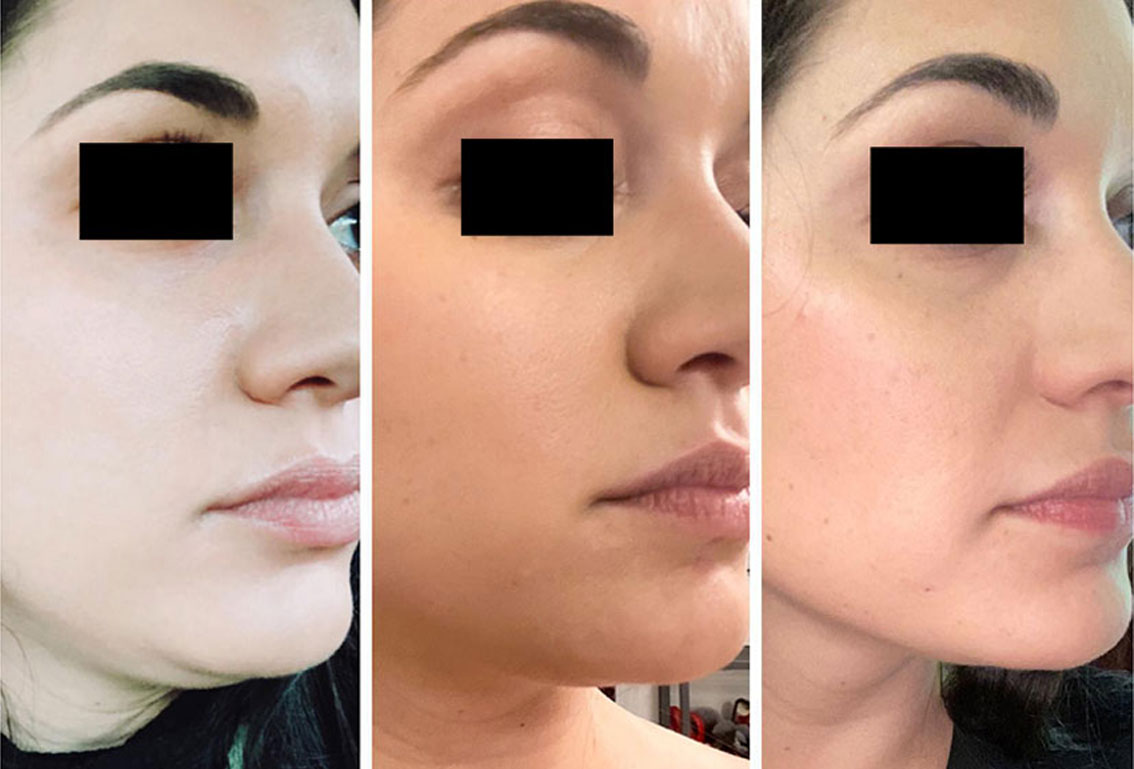 Woman's face, before and after facial,jawline and neck countouring, oblique view
