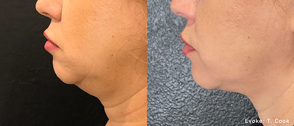 Woman's face, before and after Evoke – Facial Remodeling treatment, oblique view