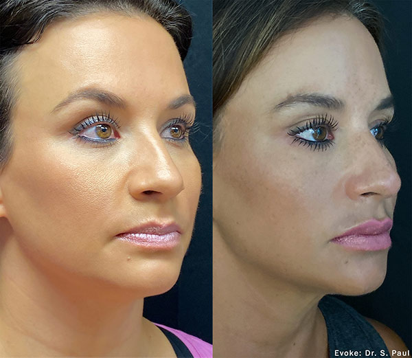 Woman's face, before and after Evoke – Facial Remodeling treatment, oblique view