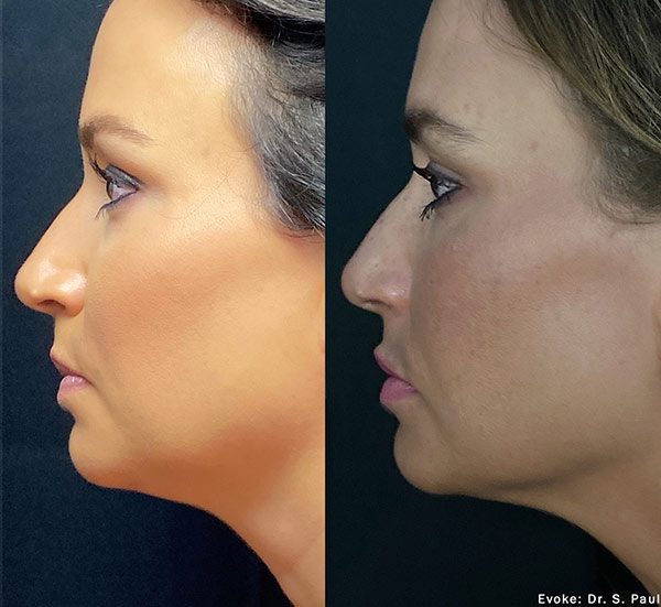 Woman's face, before and after Evoke – Facial Remodeling treatment, oblique view