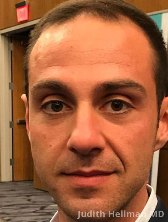 Male face, before and after skin tightening treatment. Face - front view, patient 2