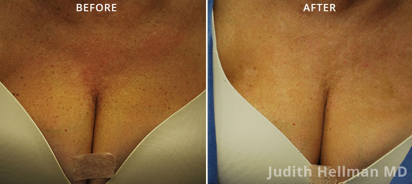 Brown Spots Treatment  McLean & Potomac Dermatology