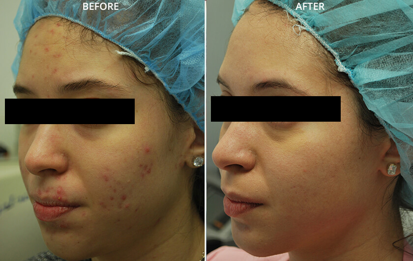 Fractora RF before and after photos NYC.