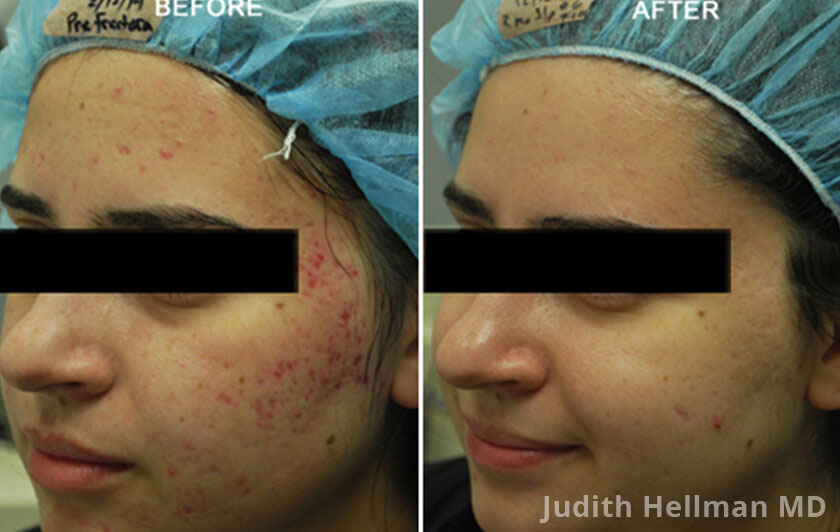 Young woman's face, before and after Fractora radio refrequency treatment. Face, forehead, left cheek - patient 8