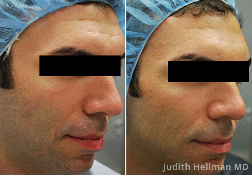 Male face, before and after Fractora radio refrequency treatment. Face, right cheek - patient 11