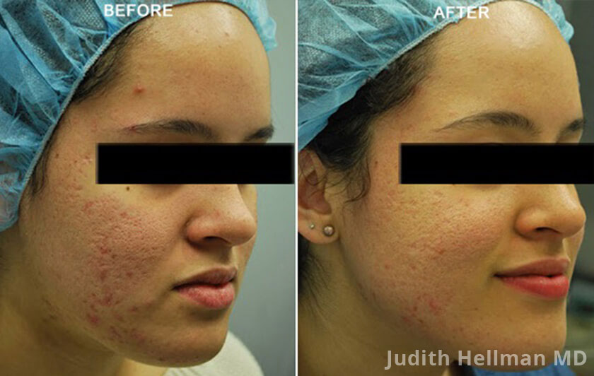 Young woman's face, before and after Fractora radio frequency treatment. Face, forehead, right cheek - patient 3