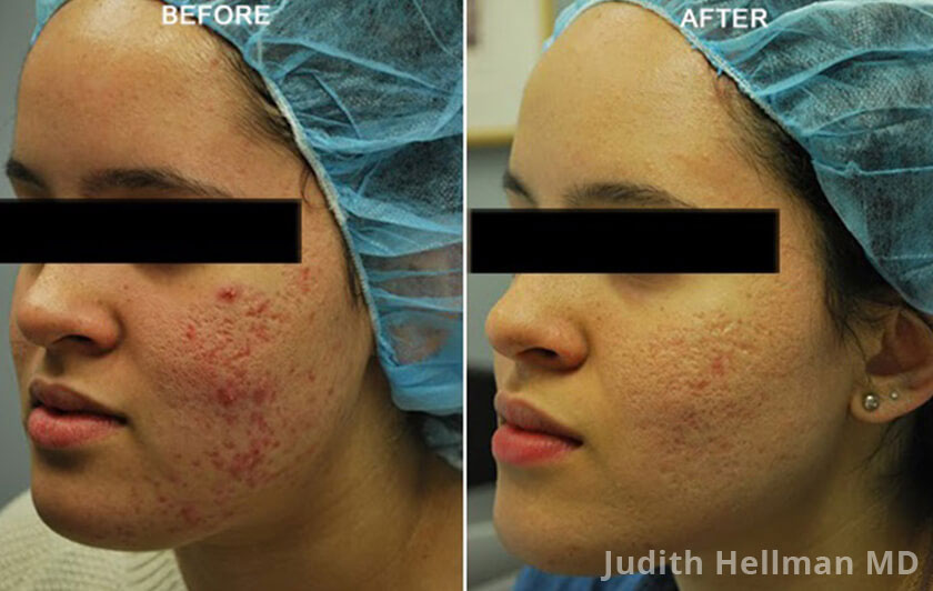 Young woman's face, before and after Fractora radio refrequency treatment. Face, forehead, left cheek - patient 3