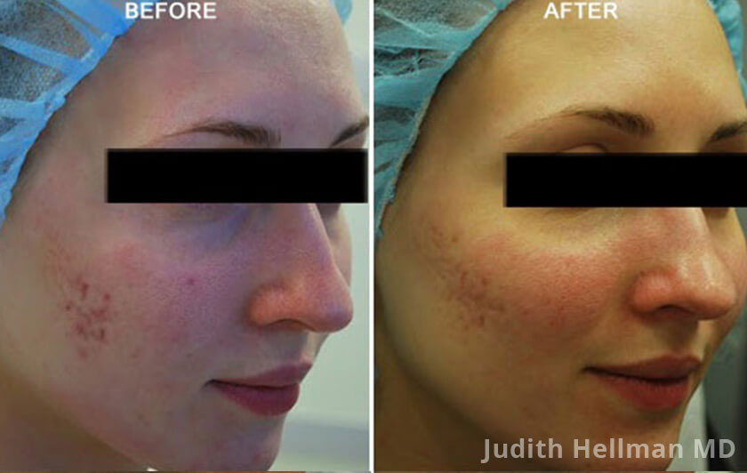 Young woman's face, before and after Fractora radio frequency treatment. Face, right cheek - patient 5