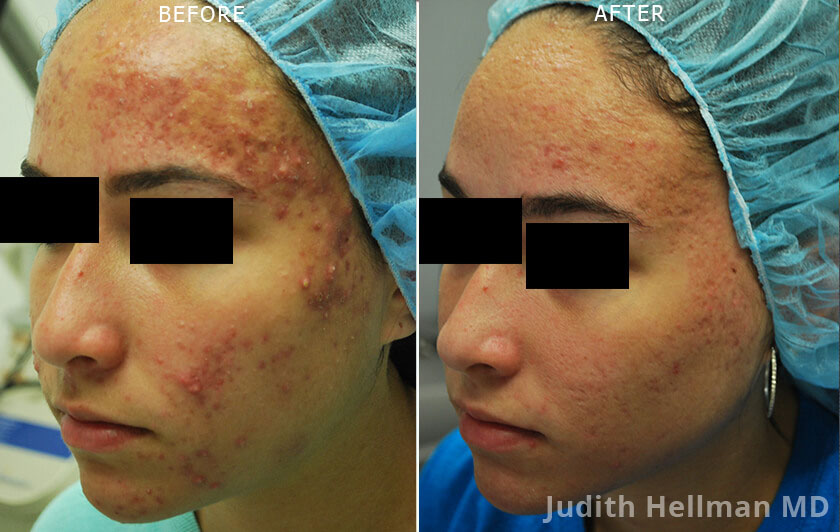 Young woman's face, before and after Fractora radio refrequency treatment. Face, forehead, cheek (left side oblique view) - patient 2
