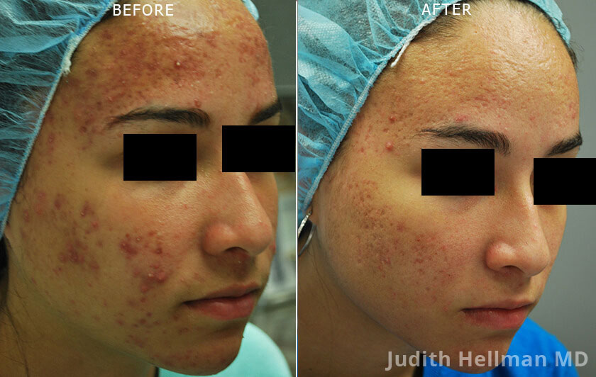 Young woman's face, before and after Fractora radio refrequency treatment. Face, forehead, cheek (right side oblique view) - patient 2