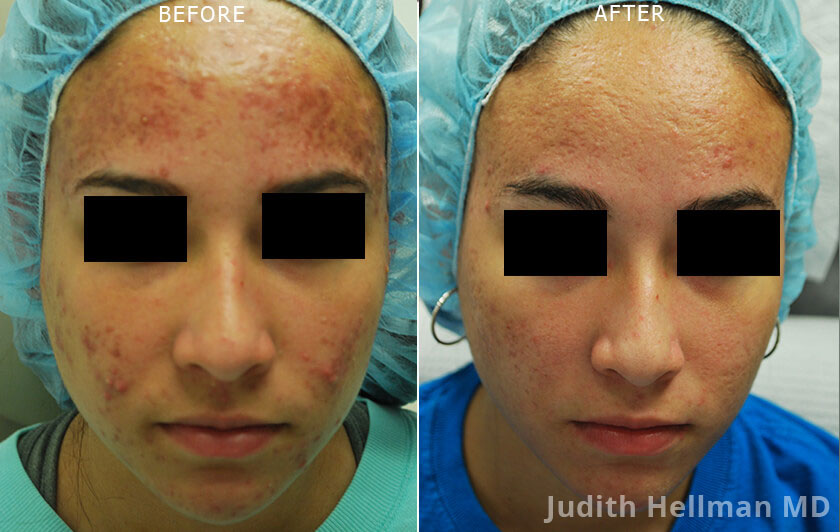 Young woman's face, before and after Fractora radio frequency treatment. Face, forehead, cheeks, front view - patient 1