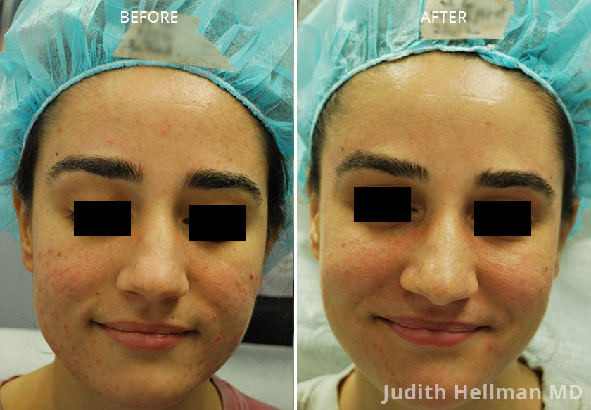 Young woman's face, before and after Fractora radio refrequency treatment. Face, forehead, cheek (front view) - patient 1