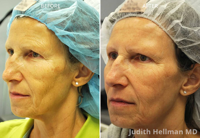 Young woman's face, before and after Fractora radio frequency treatment. Face, forehead, left cheek - patient 8