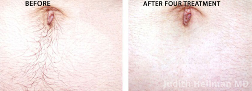 Laser Hair Removal: Before and After Photos - Male patient (face)
