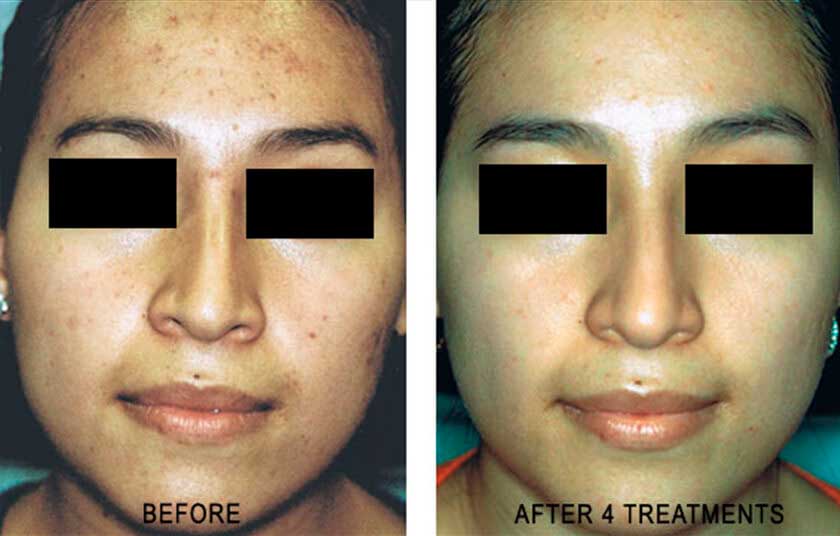 Laser for Acne New York Acne Laser Removal NYC