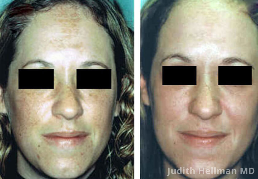 Young woman's face, before and after melasma treatment. Face, forehead front view
