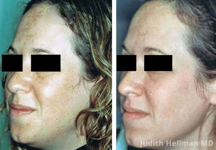 Young woman's face, before and after melasma treatment. Face, forehead, left cheek