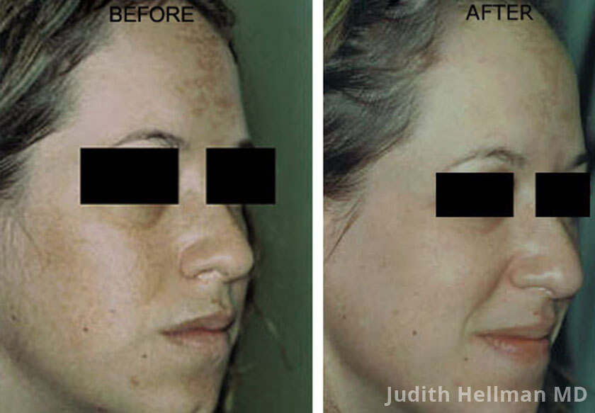 Young woman's face, before and after melasma treatment. Face, forehead, right cheek