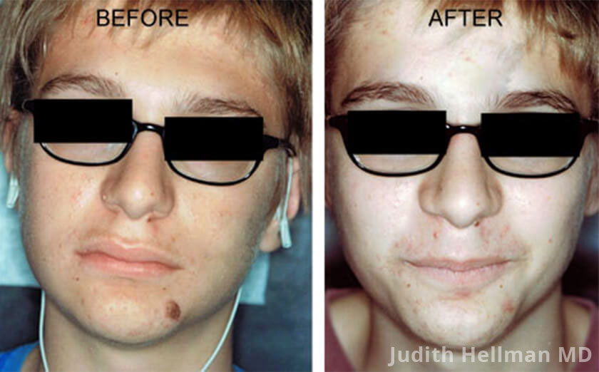 Skin Tag & Mole Removal Before & After Photos NYC Skin Tag & Mole Removal Before & After Photos NYC