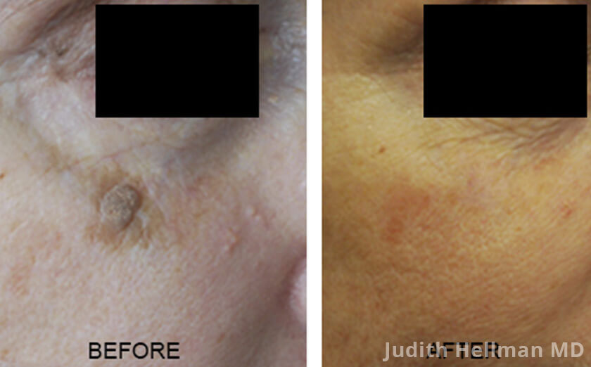 Does Aetna Insurance Cover Mole Removal Awesome