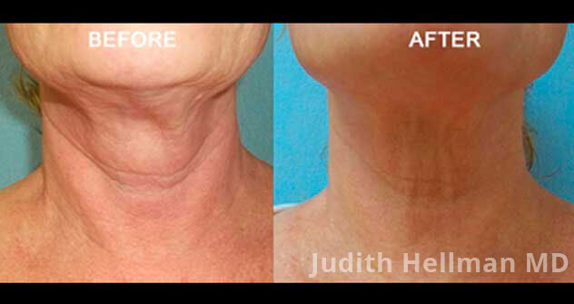 Non-surgical Neck Lift - Before and After Photos: Female (neck, frontal view)