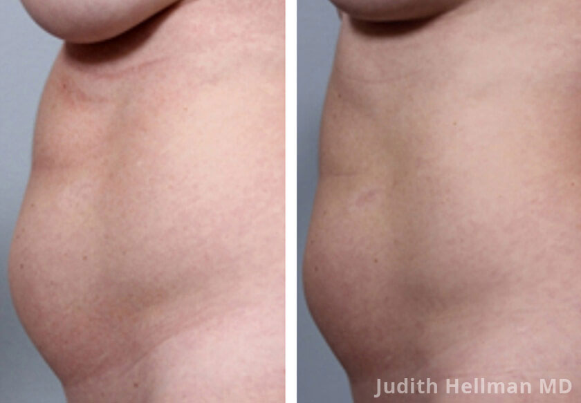 Female abdomen, before and after non surgical fat reduction treatment. Abdomen, left side view - patient 1