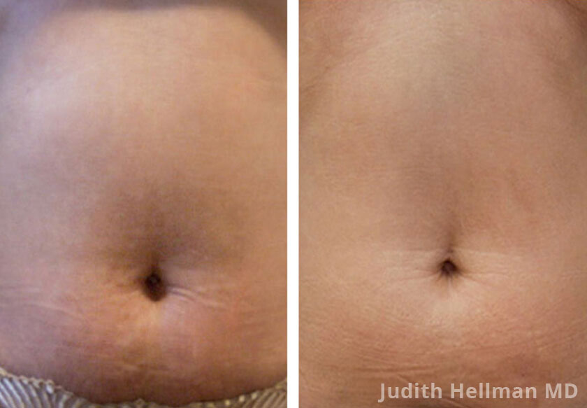 Woman's abdomen, before and after non surgical fat reduction treatment. Abdomen - patient 2