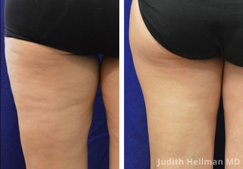 Woman's legs, before and after non surgical fat reduction treatment. Legs, back view - patient 4