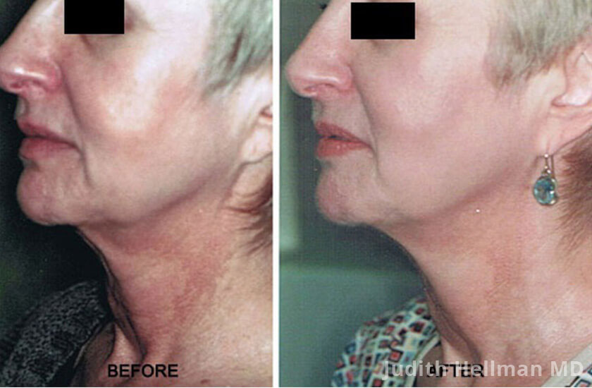 Old female neck, before and after non-surgical necklift treatment. Neck. Patient 1 (left side view)