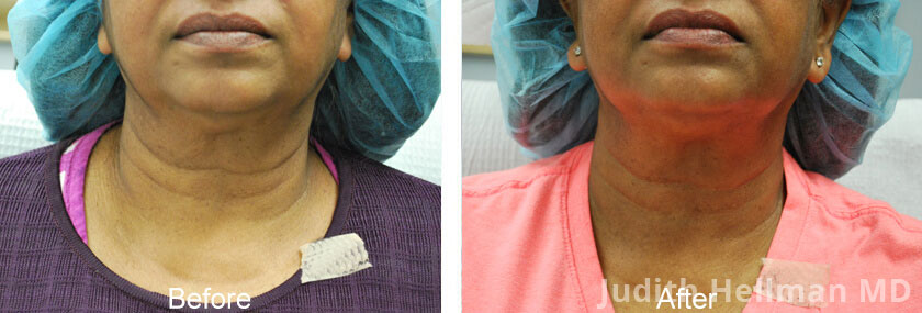 Old female neck, before and after non-surgical necklift treatment. Neck. Patient 3 (front view)