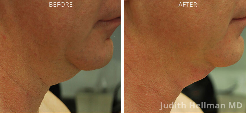 Old female neck, before and after non-surgical necklift treatment. Neck. Patient 4 (right side view)