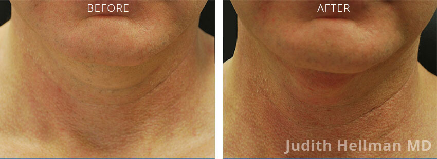 Old female neck, before and after non-surgical necklift treatment. Neck. Patient 5 (front view)